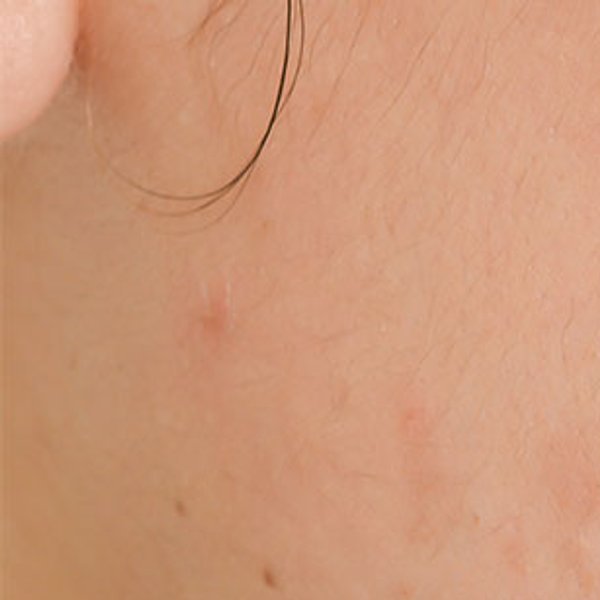 Acne Article - main image