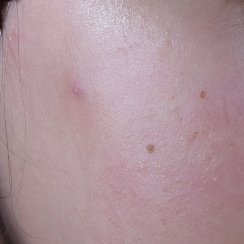 Effaclar before after