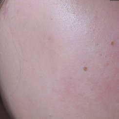 effaclar before after
