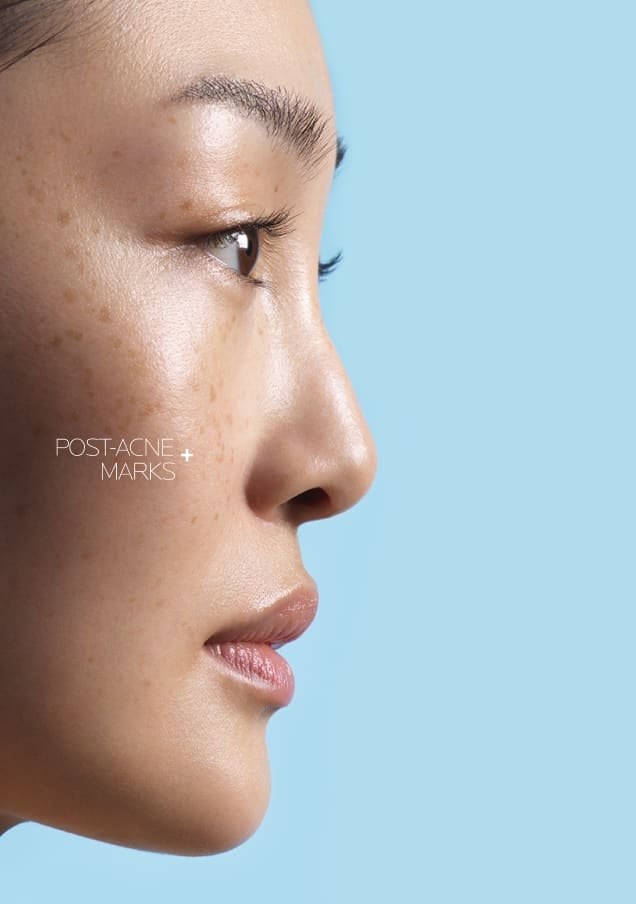 /-/media/project/loreal/brand-sites/lrp/emea/gr/products/effaclar/effaclar-a-z-gel-cream/desktop/lrp-effaclar_azcream_flip_card_front_desktop_3.jpg