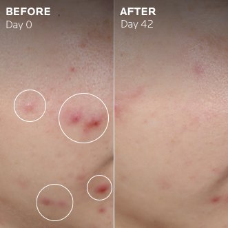 lrp-landing-effaclarserum-2022-sitecore-website-before_after-square2