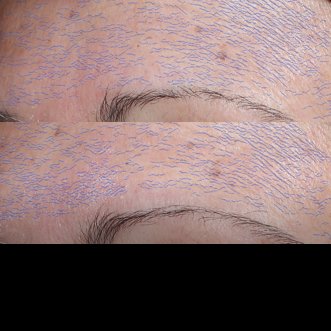 Hyalu Β5 Serum: Η Εξέλιξη της Αντιγήρανσης, μέσω της Επανόρθωσης before after image
