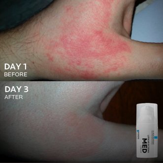 Lipikar Eczema Med Before After