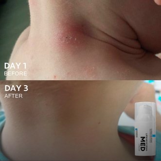 Lipikar Eczema Before After Image