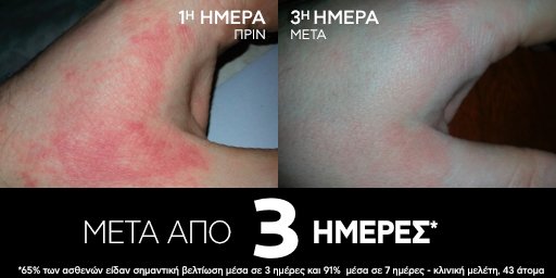 LIPIKAR ECZEMA MED ΜΕΤΑ ΑΠΟ 3 ΗΜΕΡΕΣ