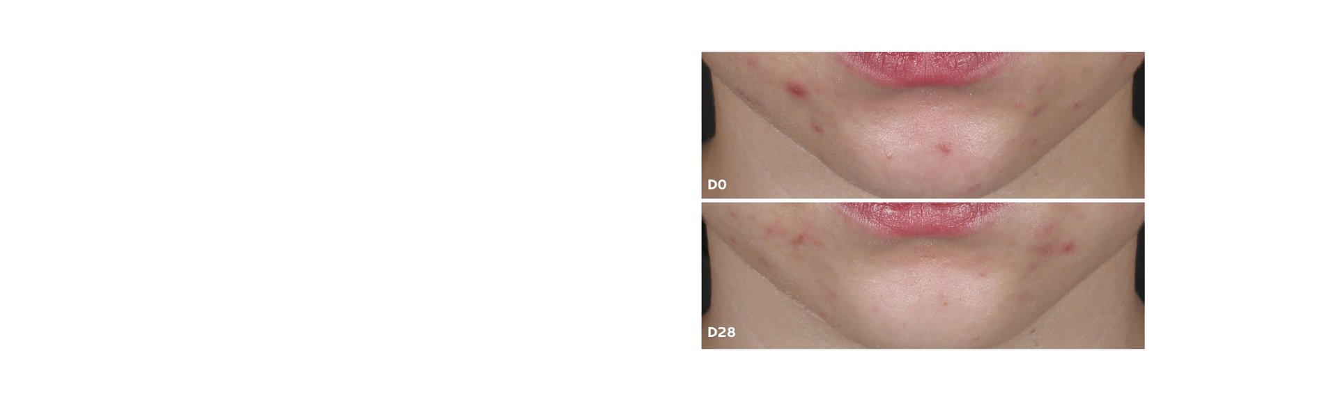 COMMITMENT ACNE BANNER