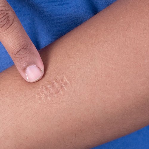 Larocheposay SubCategoryPage Damaged Scars and stitches