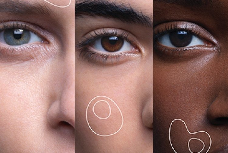 Hyperpigmentation