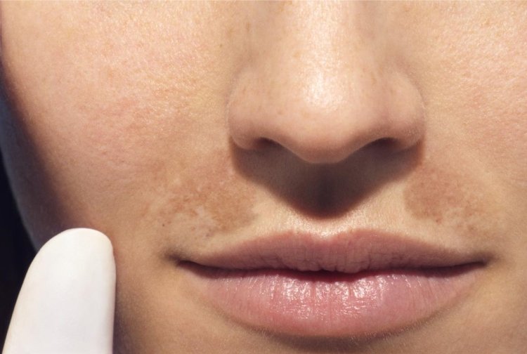 Hyperpigmentation
